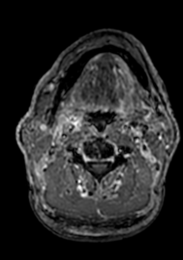 Accessory middle cerebral artery (Radiopaedia 73114-83828 Axial T1 C+ 299).jpg