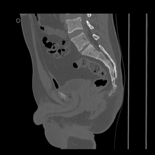 Acetabular and ilial fractures (Radiopaedia 59084-66378 Sagittal bone window 50).jpg