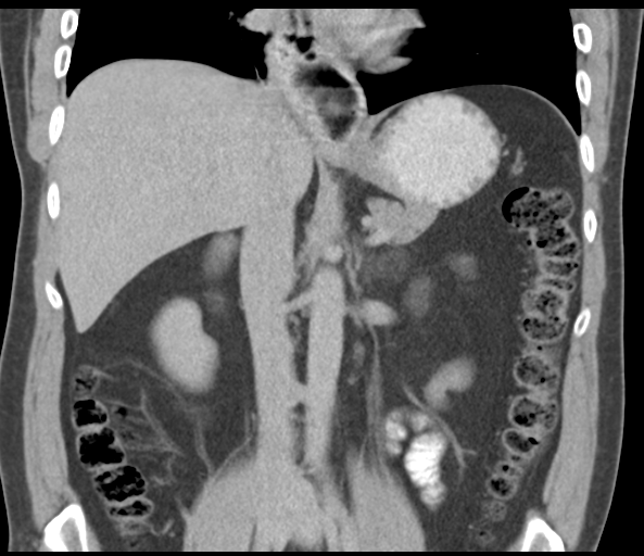 File:Achalasia of the cardia (Radiopaedia 38497-40595 Coronal C+ portal venous phase 28).png