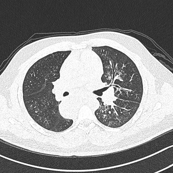 File:Achalasia with aspiration (Radiopaedia 55413-61845 Axial lung window 32).jpg
