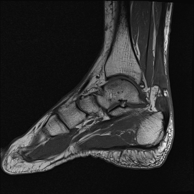 File:Achilles tendon tear (Radiopaedia 77615-89819 Sagittal T1 8).jpg