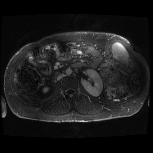 Acinar cell carcinoma of the pancreas (Radiopaedia 75442-86668 Axial T1 C+ fat sat 21).jpg