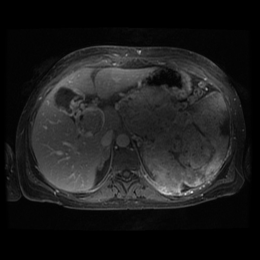 Acinar cell carcinoma of the pancreas (Radiopaedia 75442-86668 Axial T1 C+ fat sat 87).jpg