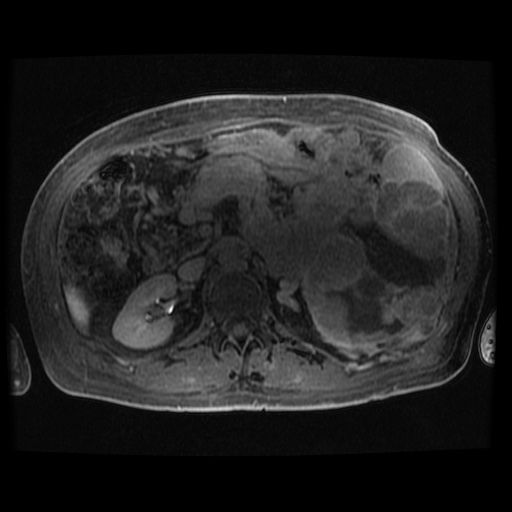 Acinar cell carcinoma of the pancreas (Radiopaedia 75442-86668 Axial late phase (~30 mins) 47).jpg