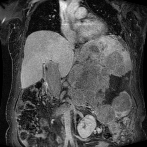 Acinar cell carcinoma of the pancreas (Radiopaedia 75442-86668 Coronal T1 C+ fat sat 108).jpg