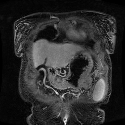 Acinar cell carcinoma of the pancreas (Radiopaedia 75442-86668 Coronal T1 C+ fat sat 158).jpg