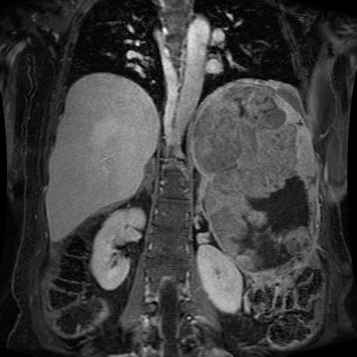 Acinar cell carcinoma of the pancreas (Radiopaedia 75442-86668 Coronal T1 C+ fat sat 75).jpg