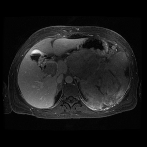 Acinar cell carcinoma of the pancreas (Radiopaedia 75442-86668 D 88).jpg