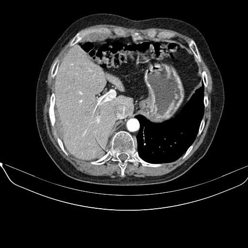 File:Acquired adrenal hyperplasia - due to thymic carcinoid tumor (Radiopaedia 21269-21184 C+ arterial phase 13).jpg