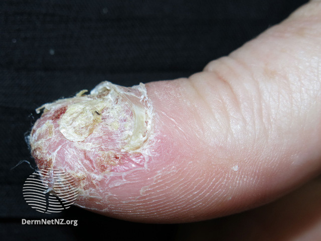 File:Acrodermatitis continua of Hallopeau (DermNet NZ scaly-acropustulosis-03).jpg