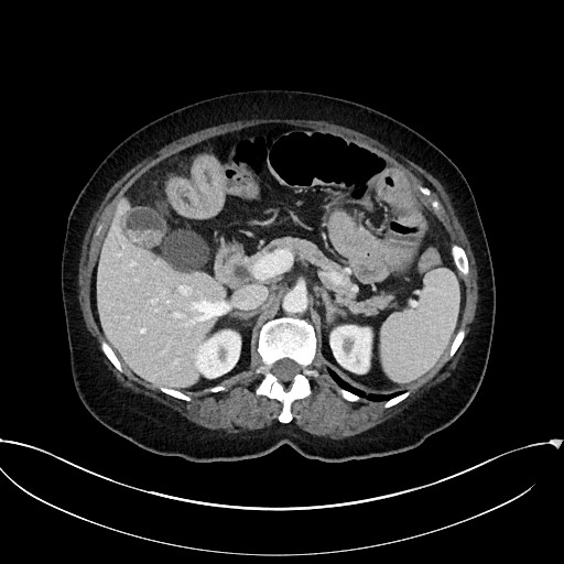 File:Active Crohn disease (Radiopaedia 59394-66750 Axial C+ portal venous phase 23).jpg