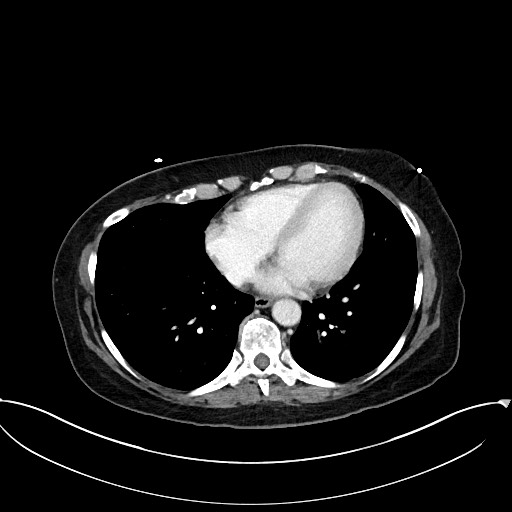 Active Crohn disease (Radiopaedia 59394-66750 Axial C+ portal venous phase 4).jpg
