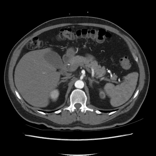 File:Active colonic bleed on CT (Radiopaedia 49765-55025 Axial C+ arterial phase 25).jpg