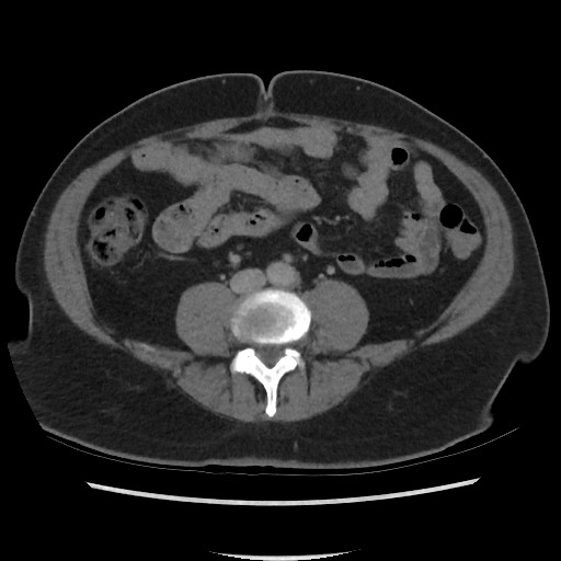 File:Active colonic bleed on CT (Radiopaedia 49765-55025 Axial C+ delayed 50).jpg