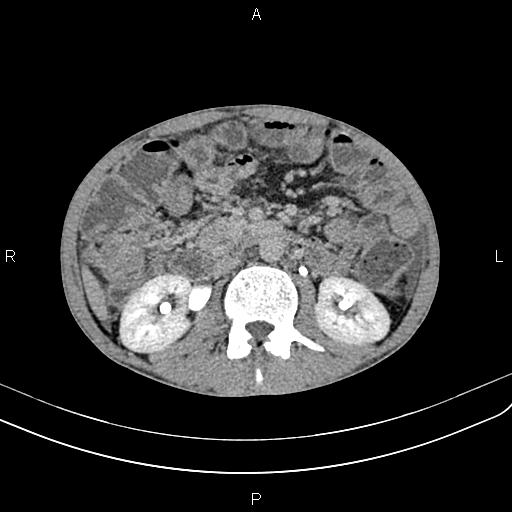 Active crohn disease (Radiopaedia 87133-103397 Axial C+ delayed 24).jpg
