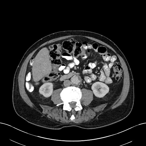 File:Active lower gastrointestinal bleeding - diverticular (Radiopaedia 61203-69106 Axial C+ portal venous phase 68).jpg