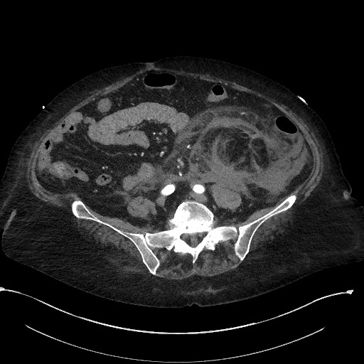 File:Active renal extravasation with large subcapsular and retroperitoneal hemorrhage (Radiopaedia 60975-68796 Axial 32).jpg
