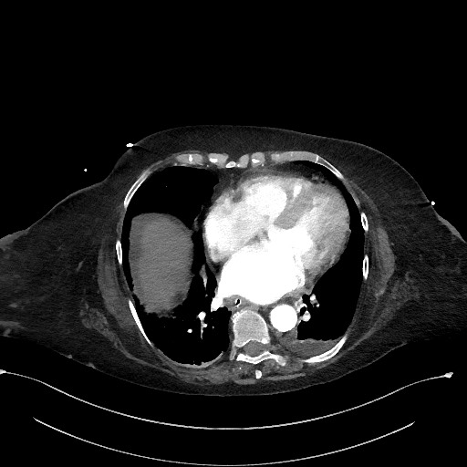 File:Active renal extravasation with large subcapsular and retroperitoneal hemorrhage (Radiopaedia 60975-68796 Axial C+ arterial phase 11).jpg