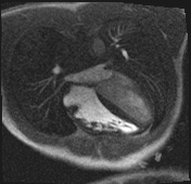 Active right ventricular cardiac sarcoidosis (Radiopaedia 55596-62100 Axial Dynamic perfusion scan MOCO 60).jpg