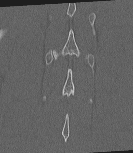 File:Acute L1 burst compression fracture (Radiopaedia 34430-35755 Coronal bone window 52).png
