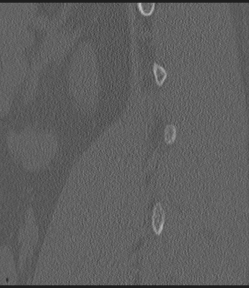 Acute L1 burst compression fracture (Radiopaedia 34430-35755 Sagittal bone window 12).png