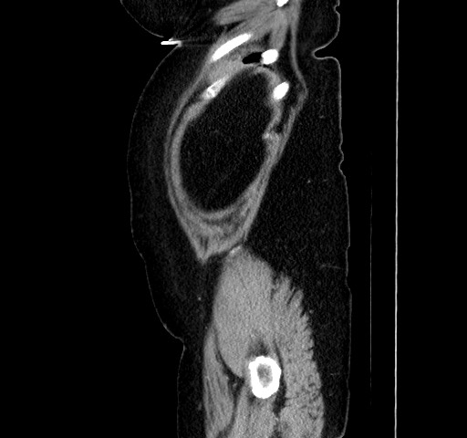 File:Acute appendicitis, heterotaxy syndrome (Radiopaedia 66884-76202 Sagittal C+ portal venous phase 23).jpg