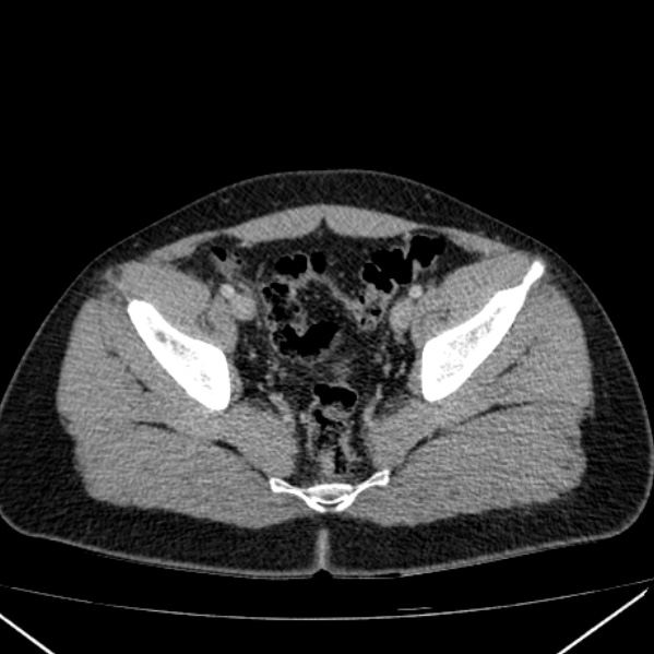 Acute appendicitis (Radiopaedia 38255-40270 Axial C+ portal venous phase 95).jpg