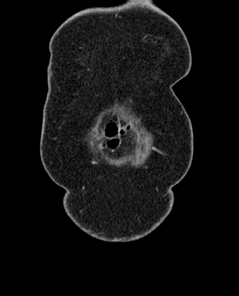 File:Acute appendicitis (Radiopaedia 48792-53822 Coronal C+ portal venous phase 14).jpg