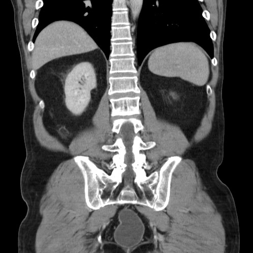 Acute appendicitis (Radiopaedia 66513-75790 Coronal C+ portal venous phase 66).jpg