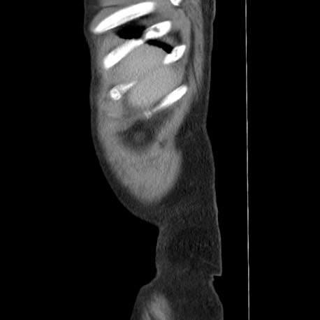 Acute appendicitis (Radiopaedia 66513-75790 Sagittal C+ portal venous phase 1).jpg