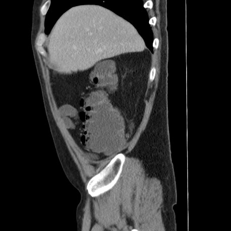 Acute appendicitis (Radiopaedia 66513-75790 Sagittal C+ portal venous phase 24).jpg