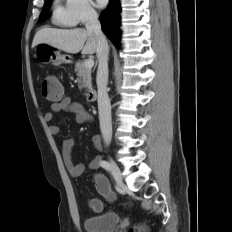 Acute appendicitis (Radiopaedia 66513-75790 Sagittal C+ portal venous phase 72).jpg