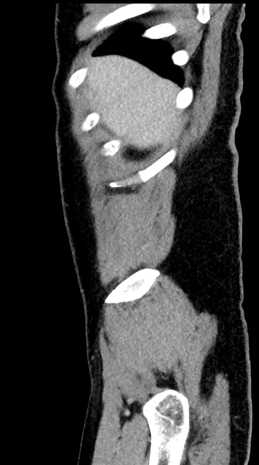 Acute appendicitis (Radiopaedia 77016-88960 Sagittal C+ portal venous phase 103).jpg