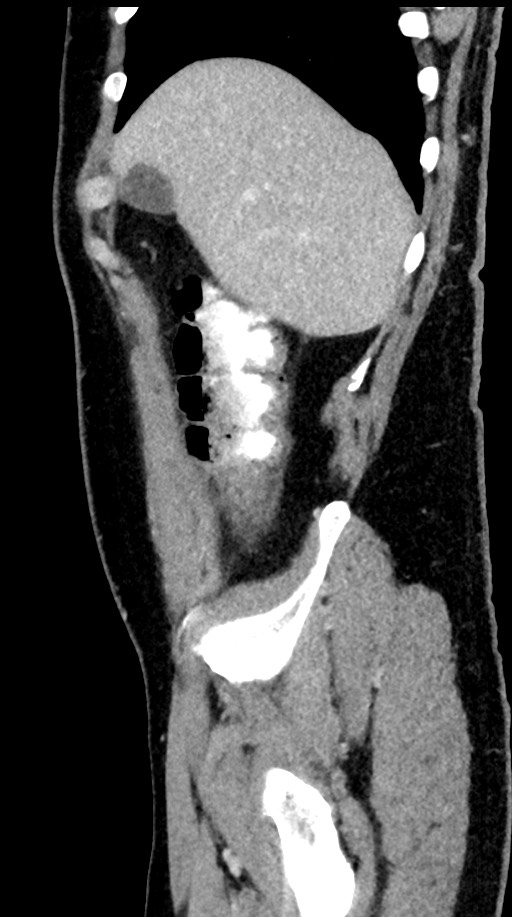Acute appendicitis (Radiopaedia 77016-88960 Sagittal C+ portal venous phase 95).jpg