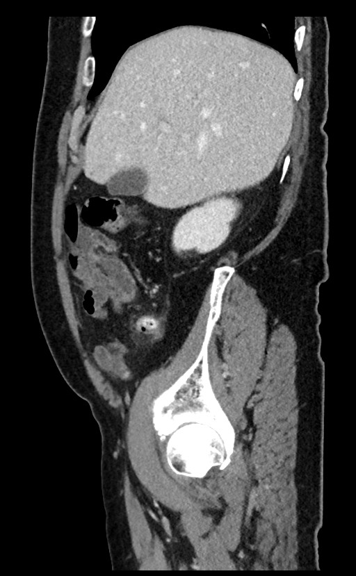 Acute appendicitis - large appendicoliths (Radiopaedia 61805-69820 Sagittal C+ portal venous phase 89).jpg