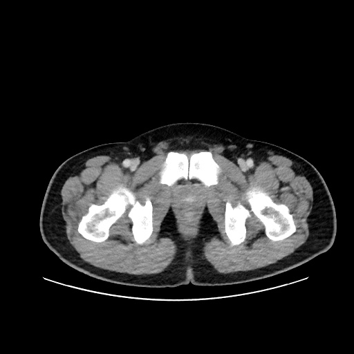 Acute appendicitis and COVID 19 pneumonia (Radiopaedia 76604-88380 Axial C+ portal venous phase 86).jpg