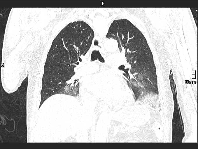 File:Acute aspiration pneumonitis (Radiopaedia 55642-62166 Coronal lung window 55).jpg