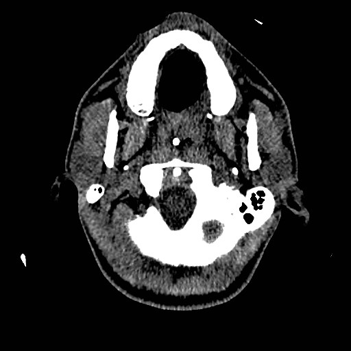 Acute basilar artery occlusion (Radiopaedia 43582-46985 Axial non-contrast 25).jpg