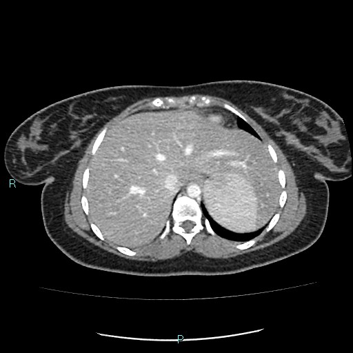 Acute bilateral pyelonephritis (Radiopaedia 37146-38881 Axial C+ portal venous phase 11).jpg