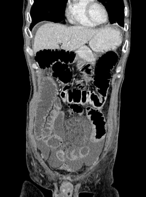 Acute bowel ischemia (Radiopaedia 87695-104114 Coronal C+ portal venous phase 125).jpg
