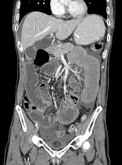 Acute bowel ischemia (Radiopaedia 87695-104114 Coronal C+ portal venous phase 173).jpg