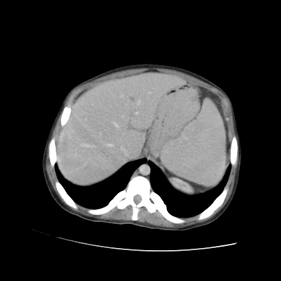Acute calculous cholecystitis in patient with osteopetrosis (Radiopaedia 77871-90159 Axial C+ portal venous phase 22).jpg