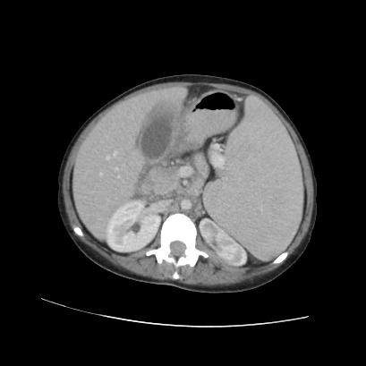 File:Acute calculous cholecystitis in patient with osteopetrosis (Radiopaedia 77871-90159 Axial C+ portal venous phase 38).jpg