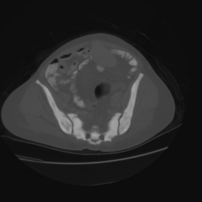 Acute calculous cholecystitis in patient with osteopetrosis (Radiopaedia 77871-90159 Axial bone window 40).jpg