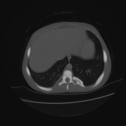 File:Acute calculous cholecystitis in patient with osteopetrosis (Radiopaedia 77871-90159 Axial bone window 5).jpg