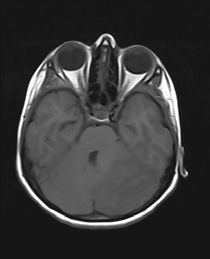 File:Acute cerebellar ataxia (Radiopaedia 61487-69446 Axial T1 7).jpg