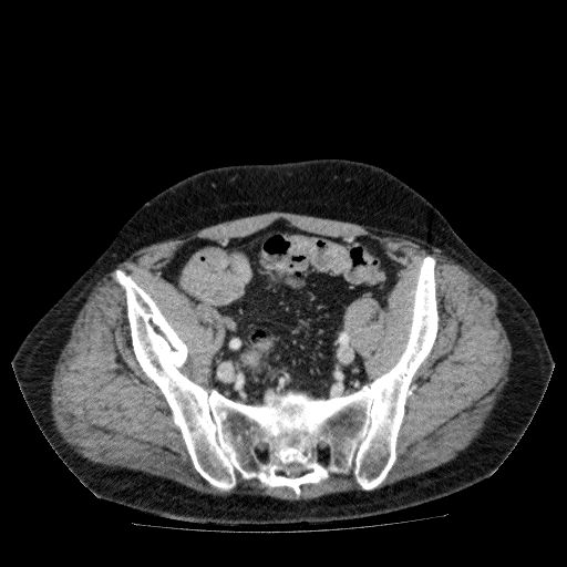 Acute cholecystitis and incidental left sided IVC (Radiopaedia 49352-54459 Axial C+ portal venous phase 123).jpg