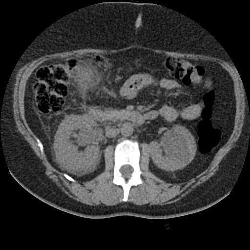 Acute cholecystitis and ureteric colic (Radiopaedia 42330-45444 Axial prone 39).jpg