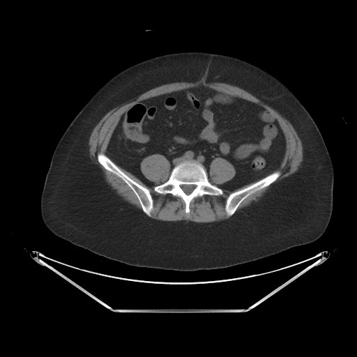 File:Acute cholecystitis with tensile fundus sign (Radiopaedia 71394-81723 Axial non-contrast 73).jpg