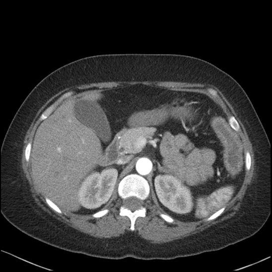 Acute colonic hemorrhage in ulcerative colitis (Radiopaedia 77415-89538 Axial C+ arterial phase 39).jpg